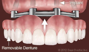 removable_denture