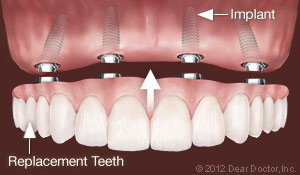 replacement_teeth_nj