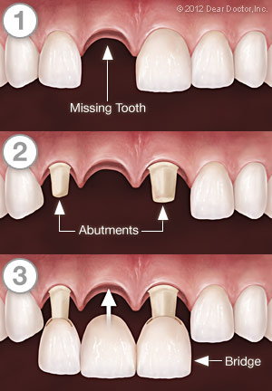 teeth_bridge